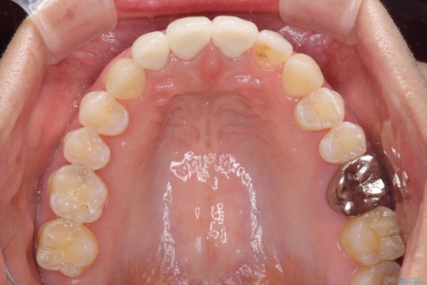 前歯の審美歯科治療　オールセラミッククラウンと下顎の部分矯正 治療後画像