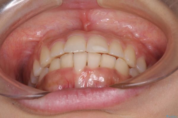 ワイヤー矯正で短期間での歯列矯正 治療後画像