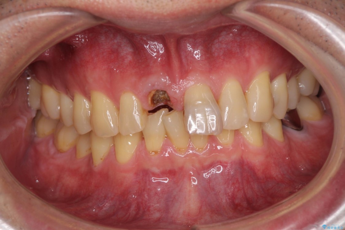 抜歯が必要な前歯　インプラントによる補綴治療 治療前