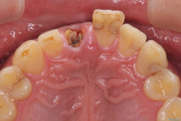抜歯が必要な前歯　インプラントによる補綴治療 治療前画像