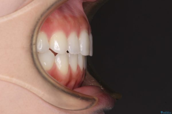 噛まない前歯を治したい　インビザラインでの矯正治療 治療後画像