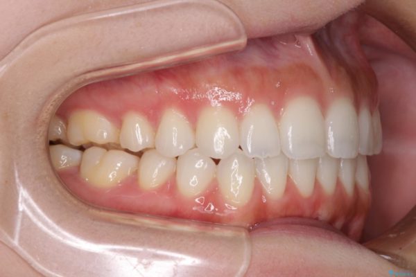 噛まない前歯を治したい　インビザラインでの矯正治療 治療後画像