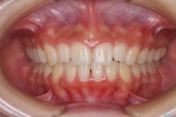 デコボコの前歯を治したい　インビザラインによる矯正治療 治療後画像