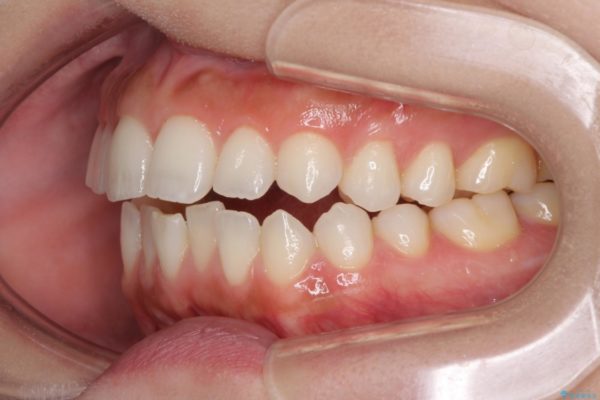 噛まない前歯を治したい　インビザラインでの矯正治療 治療前画像