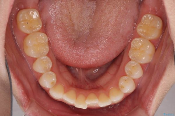 噛まない前歯を治したい　インビザラインでの矯正治療 治療前画像