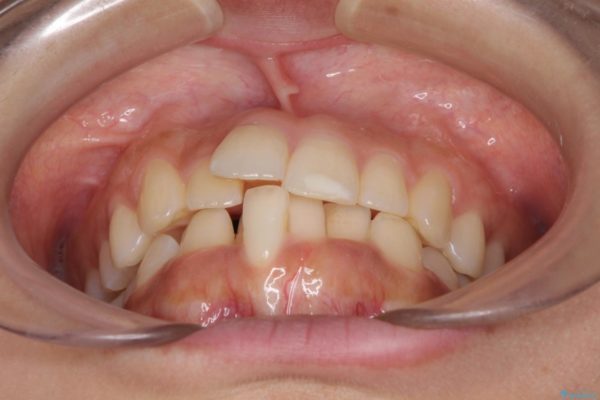 ワイヤー矯正で短期間での歯列矯正 治療前画像
