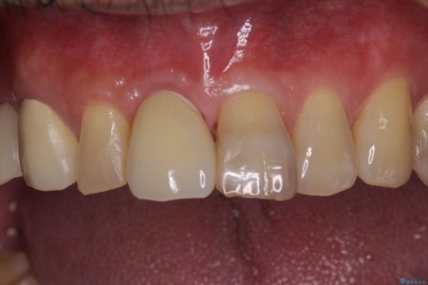 抜歯が必要な前歯　インプラントによる補綴治療 治療後画像
