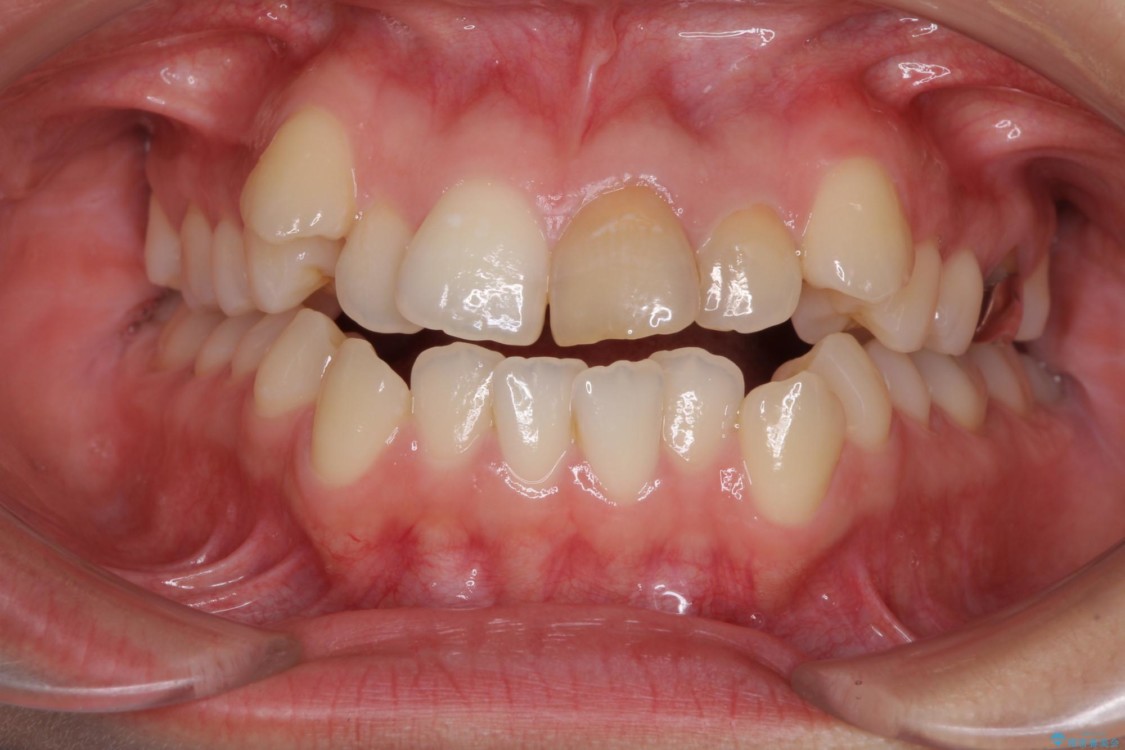抜歯矯正で八重歯を改善　費用を抑えた装置 治療前