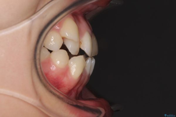 抜歯矯正で八重歯を改善　費用を抑えた装置 治療前画像