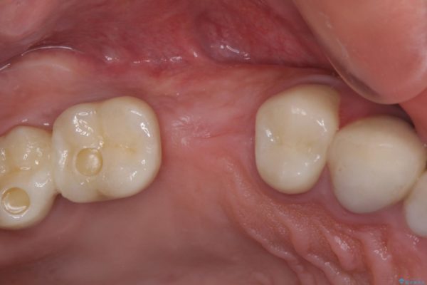 強い咬合力で折れてしまった歯　インプラントによる補綴治療 治療後画像