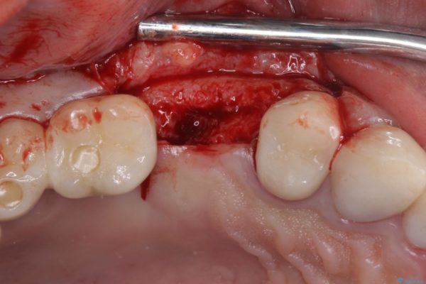 強い咬合力で折れてしまった歯　インプラントによる補綴治療 治療前画像