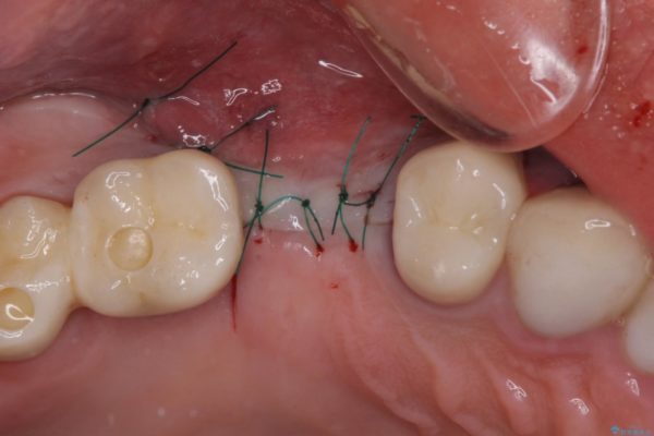 強い咬合力で折れてしまった歯　インプラントによる補綴治療 治療前画像