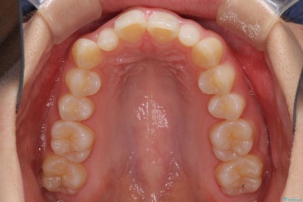 デコボコの前歯を治したい　インビザラインによる矯正治療 治療前画像