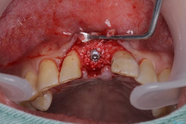 抜歯が必要な前歯　インプラントによる補綴治療 治療後画像
