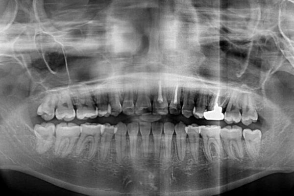 抜歯矯正で八重歯を改善　費用を抑えた装置 治療後画像