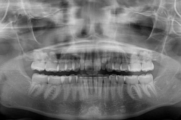デコボコの前歯を治したい　インビザラインによる矯正治療 治療後画像