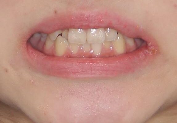 前歯のクロスバイト　メタル装置での矯正治療 治療前画像