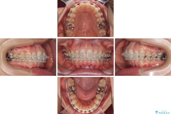 深い咬み合わせと奥歯のむし歯　総合歯科治療 治療途中画像