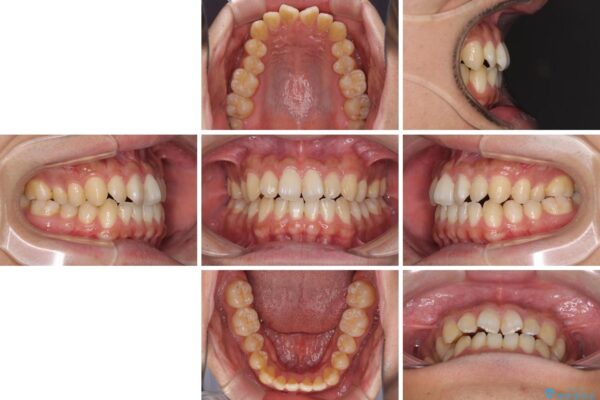 下顎前歯と上顎の部分矯正の適用例 治療前画像