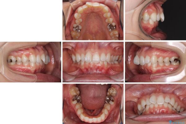 深い咬み合わせと奥歯のむし歯　総合歯科治療 治療前画像