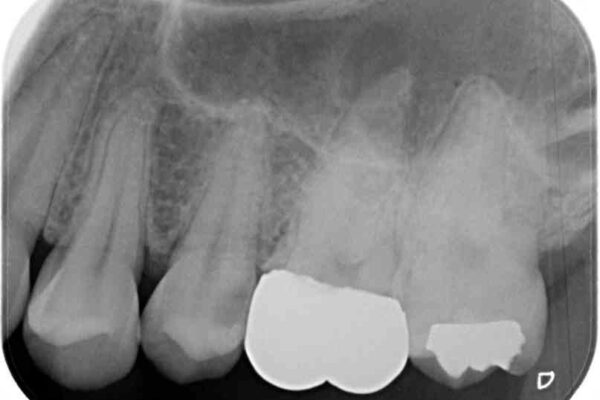 目立つ銀歯を治したい　奥歯のむし歯治療、PGAインレーとオールセラミッククラウン 治療前画像