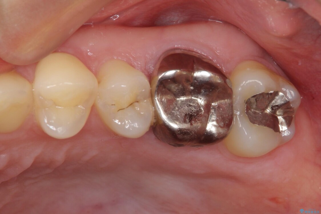 目立つ銀歯を治したい　奥歯のむし歯治療、PGAインレーとオールセラミッククラウン 治療前