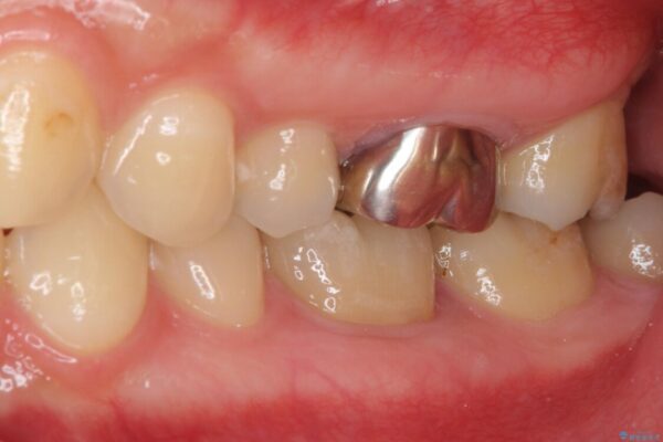 目立つ銀歯を治したい　奥歯のむし歯治療、PGAインレーとオールセラミッククラウン 治療前画像