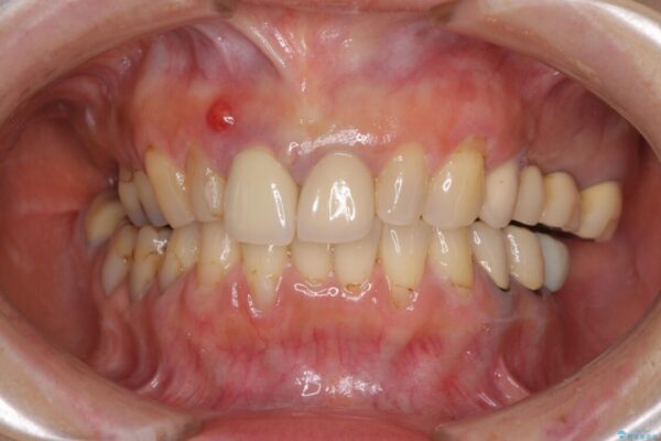 折れてしまった前歯をオールセラミックブリッジで自然な口元に 治療前画像
