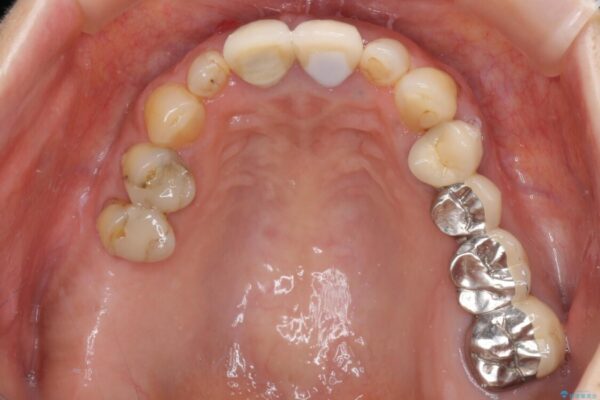 折れてしまった前歯をオールセラミックブリッジで自然な口元に 治療前画像