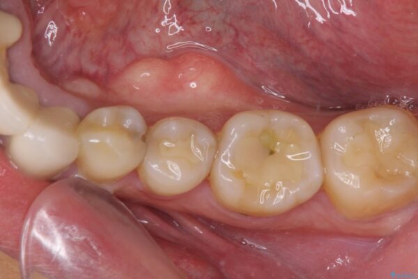 舌側の骨隆起切除とセラミックインレーによるむし歯治療 ビフォー