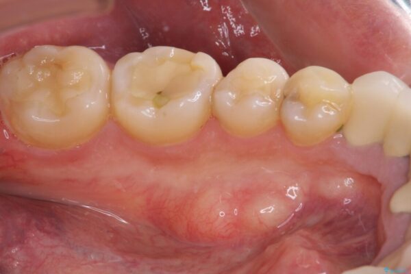 舌側の骨隆起切除とセラミックインレーによるむし歯治療 治療前画像
