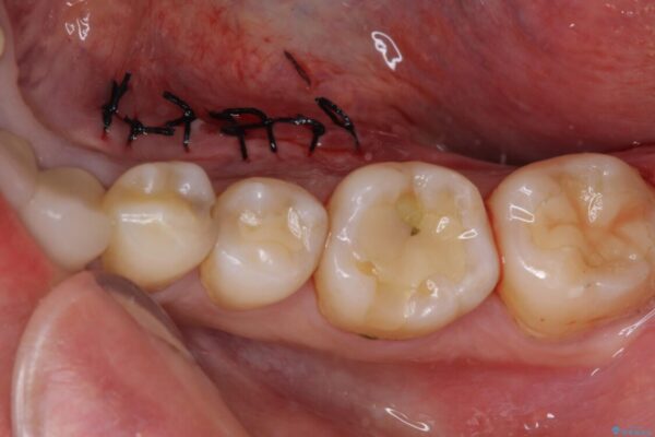 舌側の骨隆起切除とセラミックインレーによるむし歯治療 治療途中画像