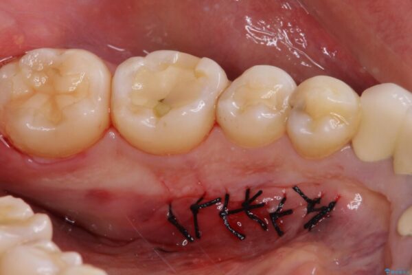 舌側の骨隆起切除とセラミックインレーによるむし歯治療 治療途中画像