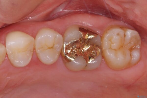 深い咬み合わせと奥歯のむし歯　総合歯科治療 治療後画像