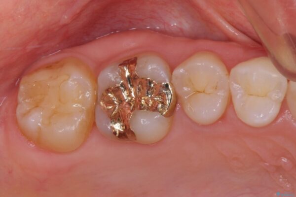 深い咬み合わせと奥歯のむし歯　総合歯科治療 治療後画像