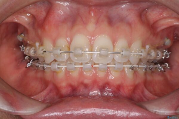 深い咬み合わせと奥歯のむし歯　総合歯科治療 治療途中画像