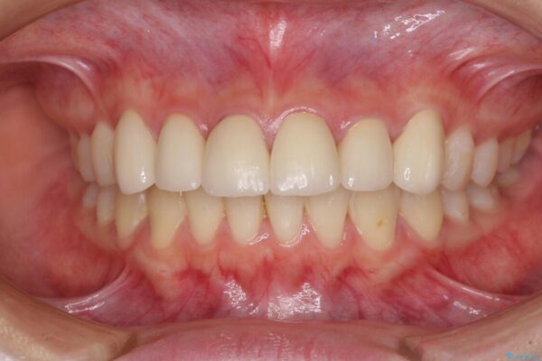 継ぎ接ぎだらけの前歯を綺麗なオールセラミックに 治療後画像