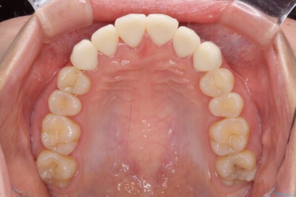 継ぎ接ぎだらけの前歯を綺麗なオールセラミックに 治療後画像