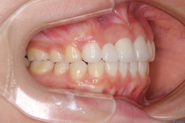 欠損歯と矮小歯　矯正治療と前歯のセラミック治療で理想的な歯列に 治療後画像