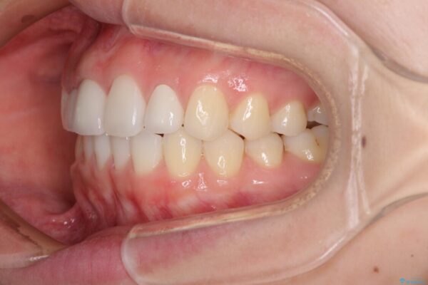 欠損歯と矮小歯　矯正治療と前歯のセラミック治療で理想的な歯列に 治療後画像