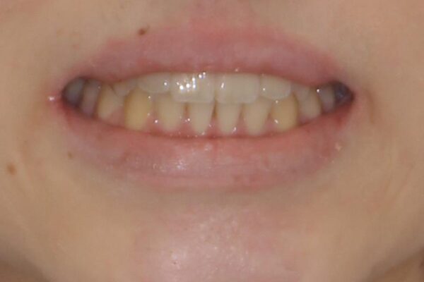前歯のクロスバイト　メタル装置での矯正治療 治療後画像