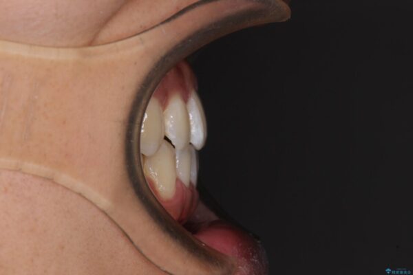 下顎前歯と上顎の部分矯正の適用例 治療後画像