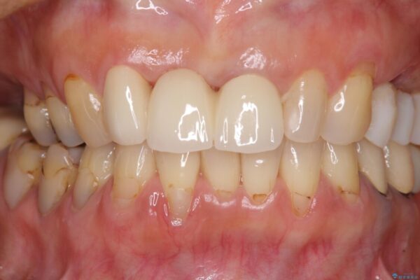 折れてしまった前歯をオールセラミックブリッジで自然な口元に 治療後画像
