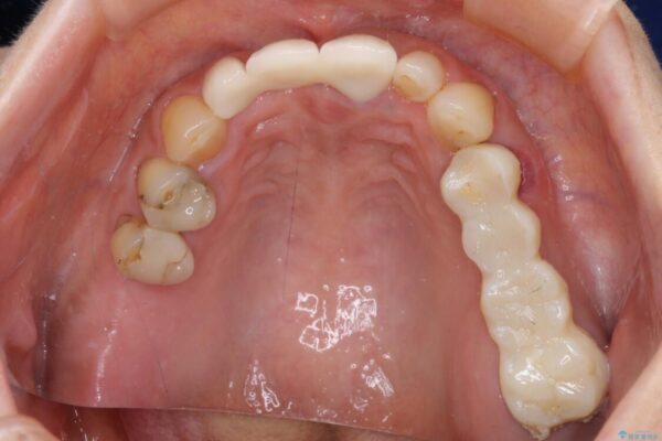 折れてしまった前歯をオールセラミックブリッジで自然な口元に 治療後画像
