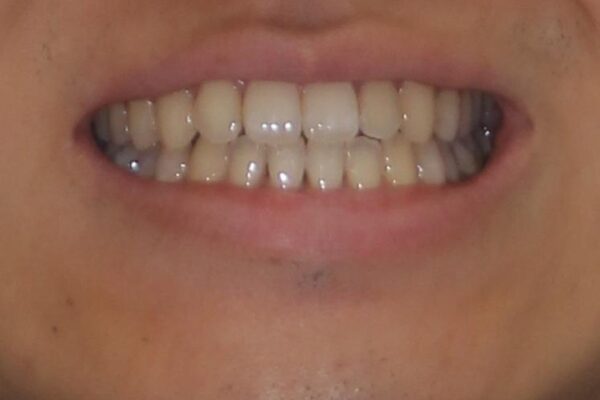 下顎前歯と上顎の部分矯正の適用例 治療後画像