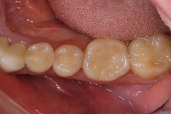舌側の骨隆起切除とセラミックインレーによるむし歯治療 治療後画像