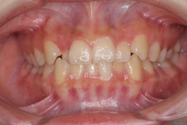 前歯のクロスバイト　メタル装置での矯正治療 治療前画像