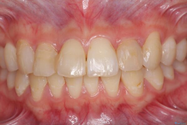 継ぎ接ぎだらけの前歯を綺麗なオールセラミックに 治療前画像