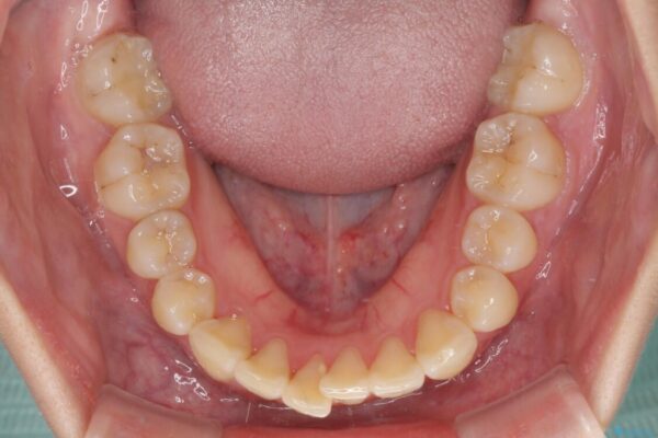 継ぎ接ぎだらけの前歯を綺麗なオールセラミックに 治療前画像