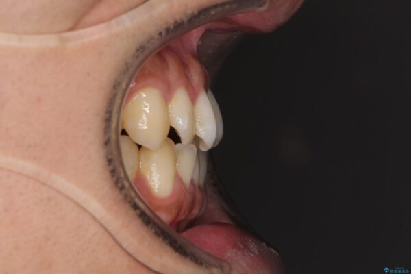 下顎前歯と上顎の部分矯正の適用例 治療前画像